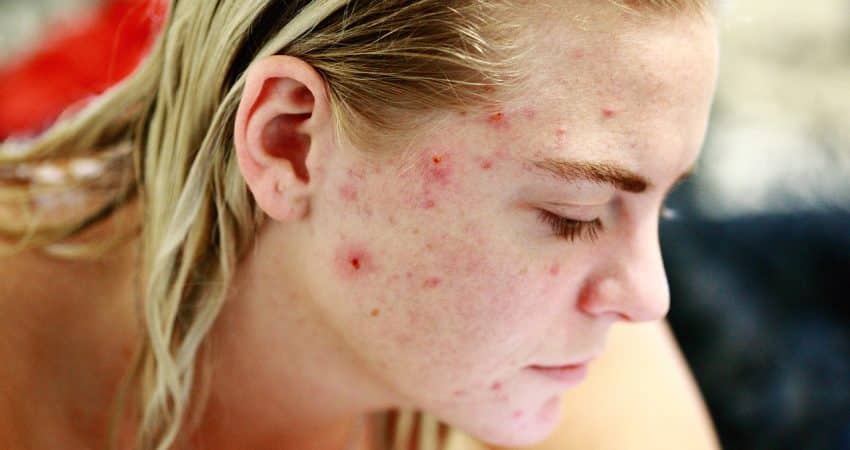 struggle, acne, self love